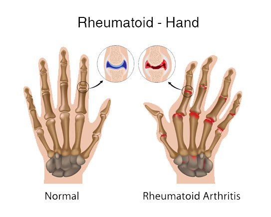 Rheumatoid-Arthritis-Industry